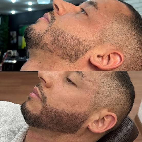 Pigmentação de Barba